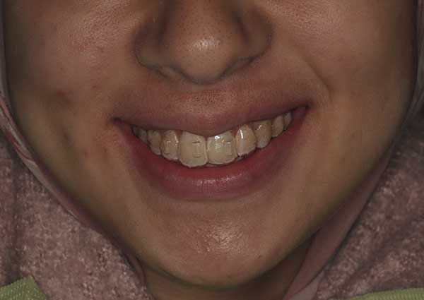 Transparent Ortho Aligners