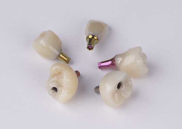 Dental Implants