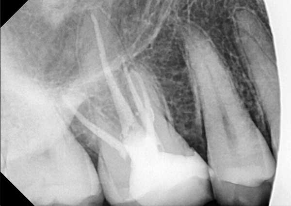 Root Canal Treatment