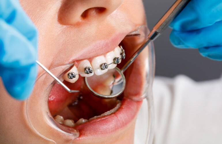 Orthodontic Treatment