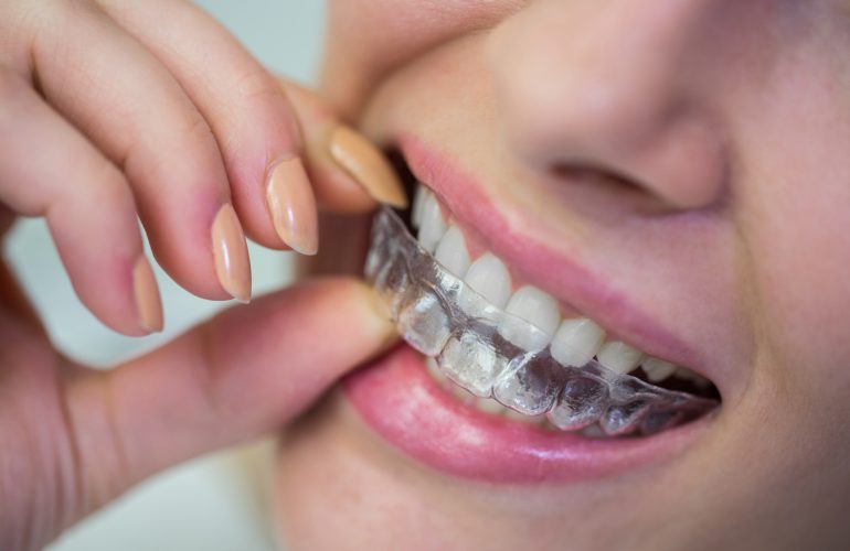 تقويم الاسنان الشفاف