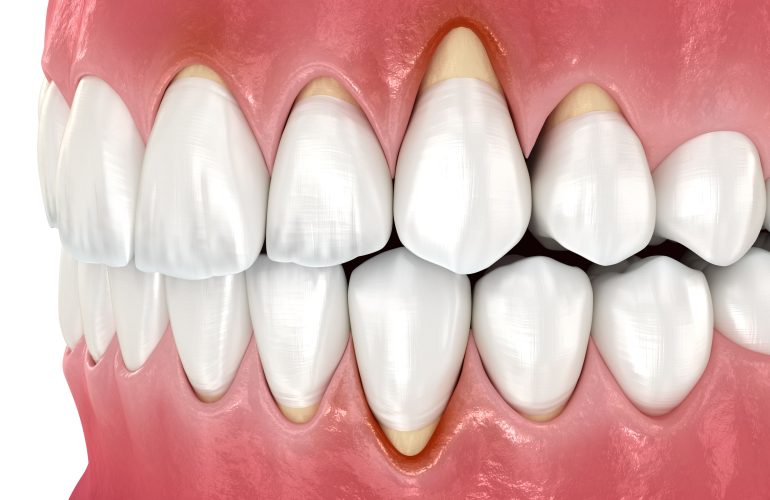 انحسار اللثة