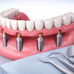 All on 4 dental implants