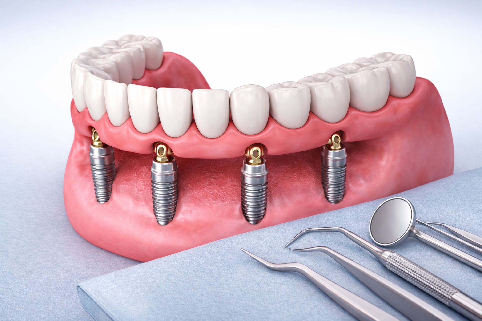 All on 4 dental implants