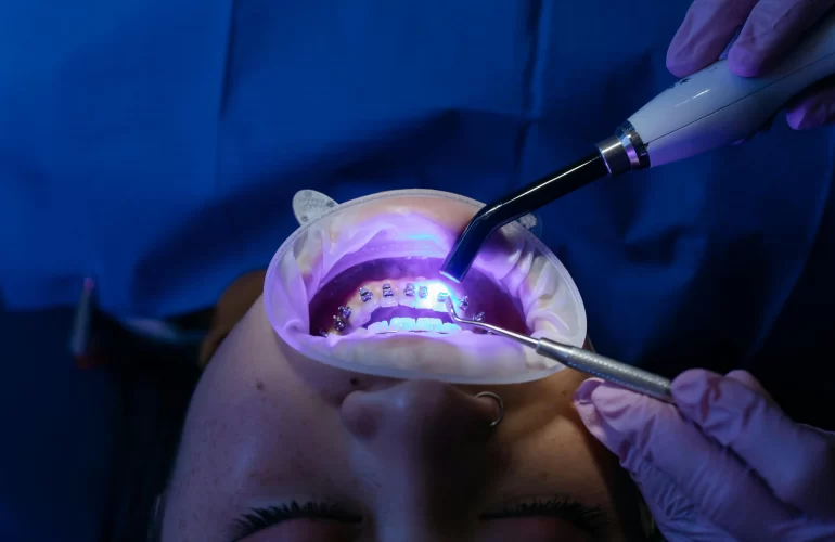 Laser Teeth Whitening in Egypt Types and Benefits by Zakaria dental clinic