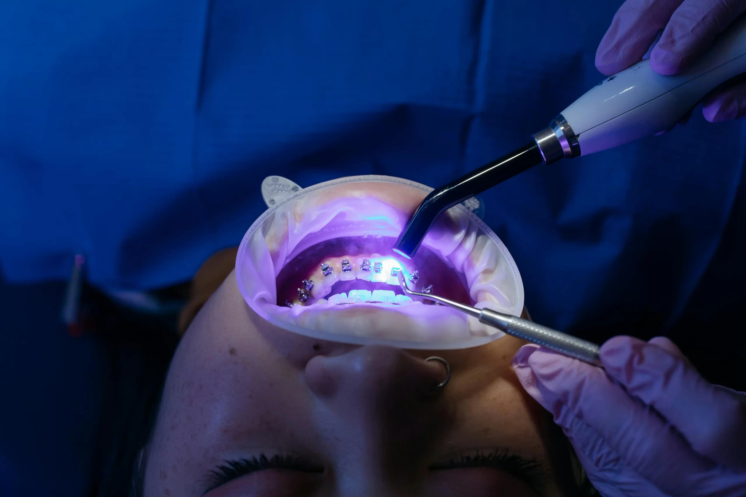 Laser Teeth Whitening in Egypt Types and Benefits by Zakaria dental clinic