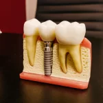 Immediate Dental Implants Same-Day Solution