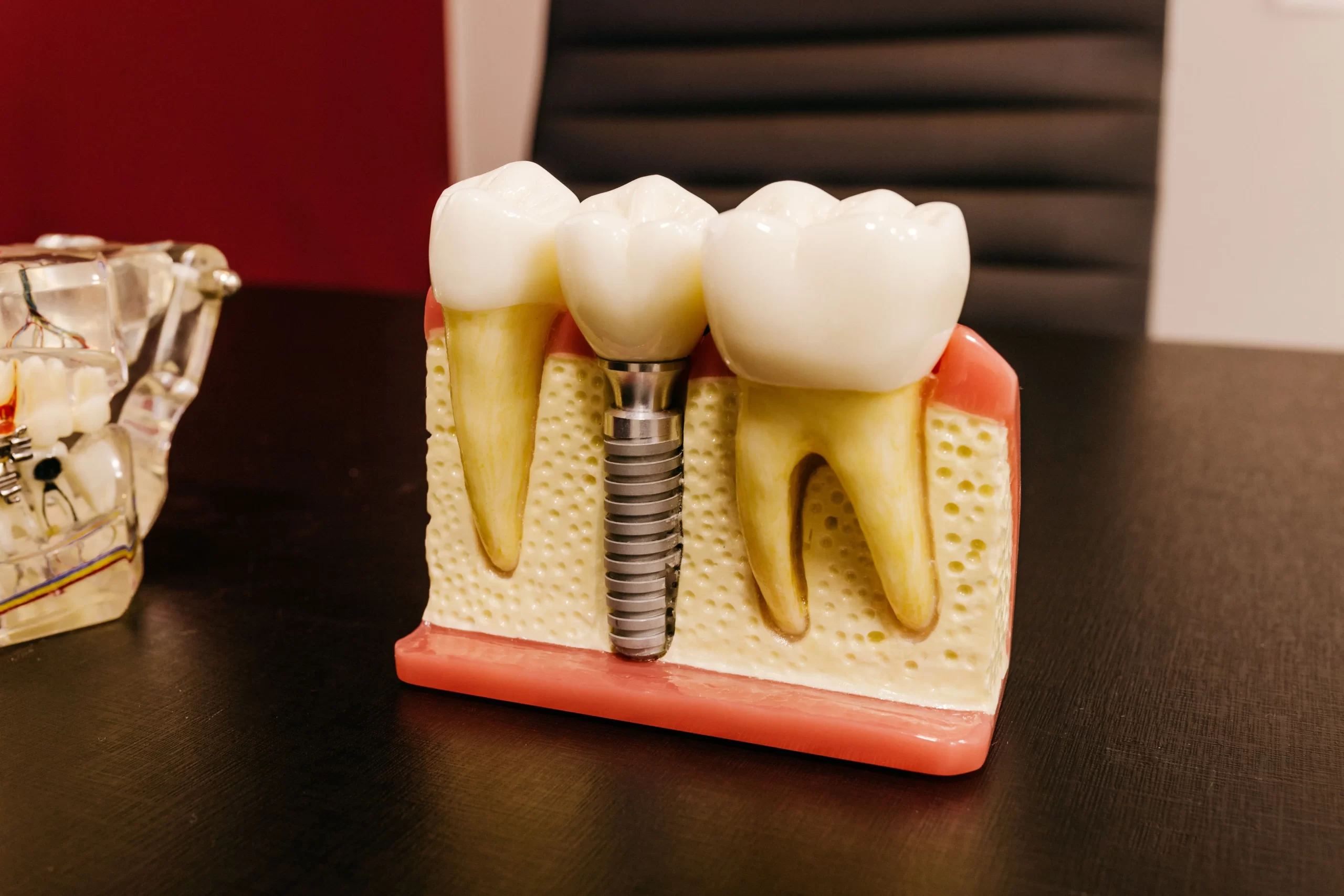 Immediate Dental Implants Same-Day Solution