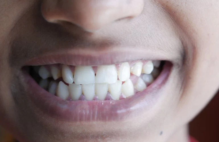 أسباب التهاب اللثة الأعراض والأنواع والوقاية و العلاج